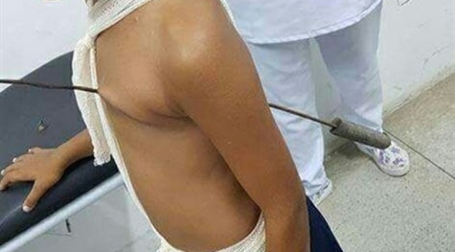 Menino tem o coração perfurado por espeto de churrasco e sobrevive
