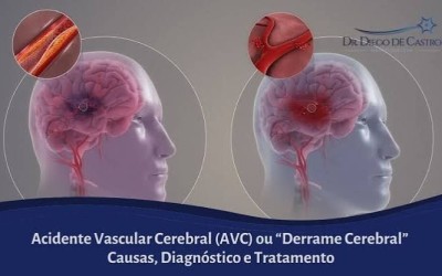 Acidente Vascular Cerebral (AVC): sintomas, causas e tratamentos