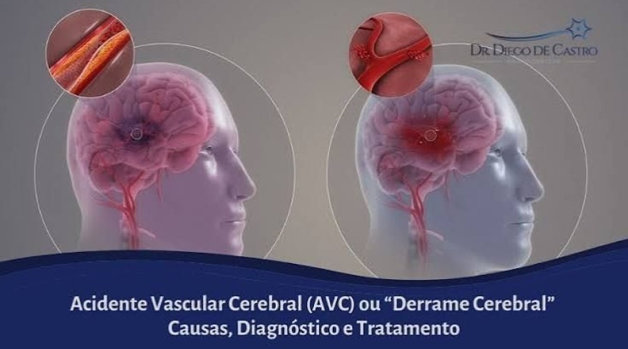 Acidente Vascular Cerebral (AVC): sintomas, causas e tratamentos