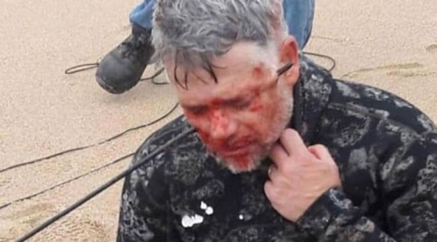 Imagem chocante! Homem acerta arpão na própria cabeça durante mergulho