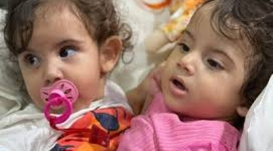 Após 19 horas, hospital conclui cirurgia de separação de gêmeas siamesas