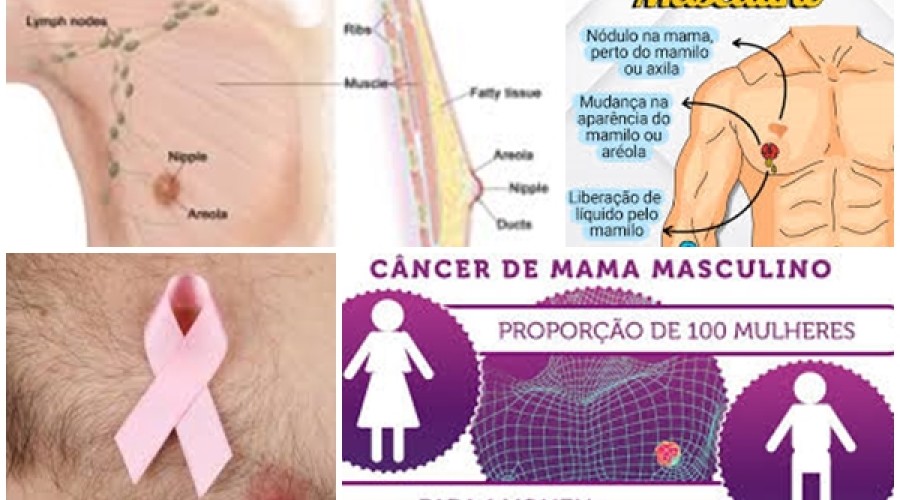 Saúde: Homens - Câncer de mama, sinais, sintomas, diagnóstico e tratamento