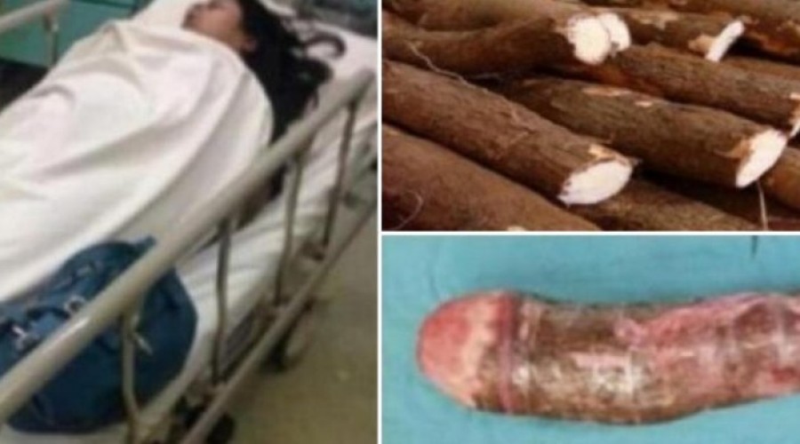 Mulher e vai parar no Hospital ao “brincar” com macaxeira de 30cm entalada em sua parte íntima VEJA