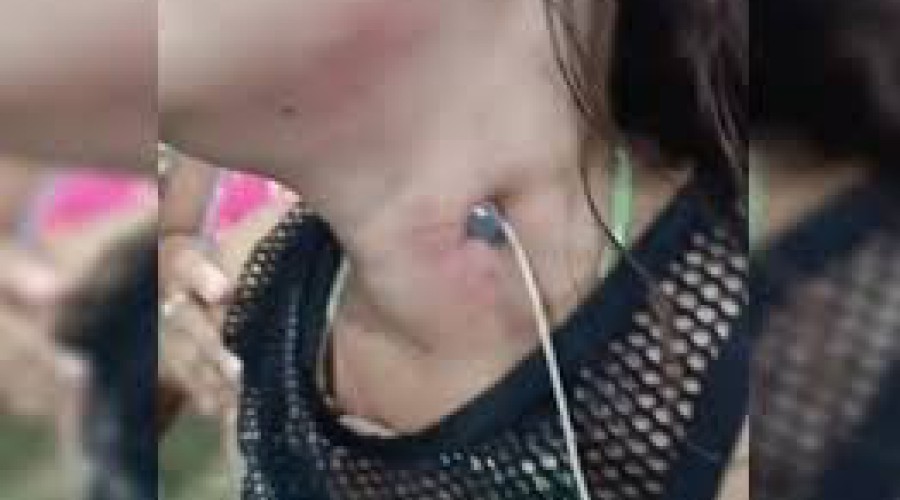 CRIME BRUTAL: Homem crava prego no pescoço da namorada e foge