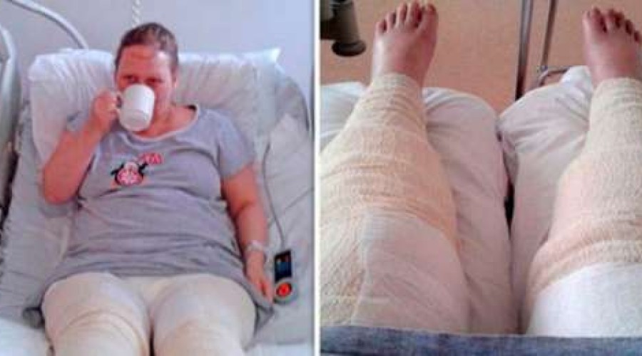 Mulher fica em coma e quase perde as pernas após depilação