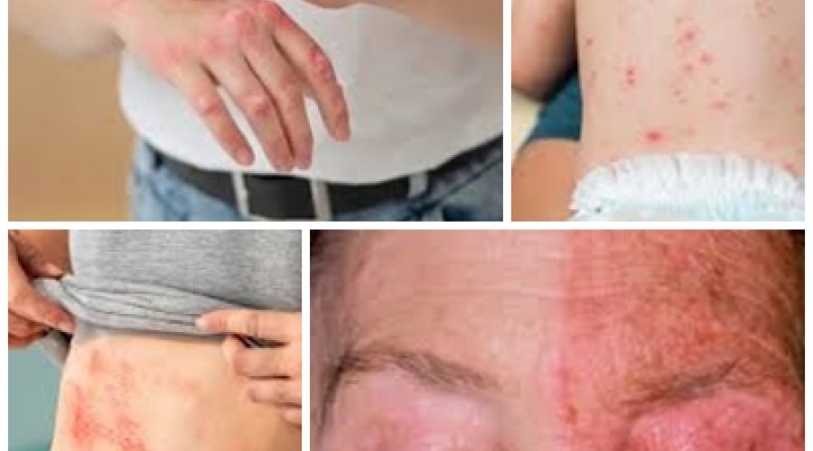 Dica de Saúde: Herpes-Zóster: O que é, sintomas, tratamentos e causas.