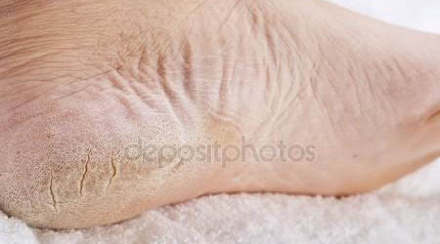 Aprenda a cuidar das rachaduras nos pés com tratamentos caseiros!