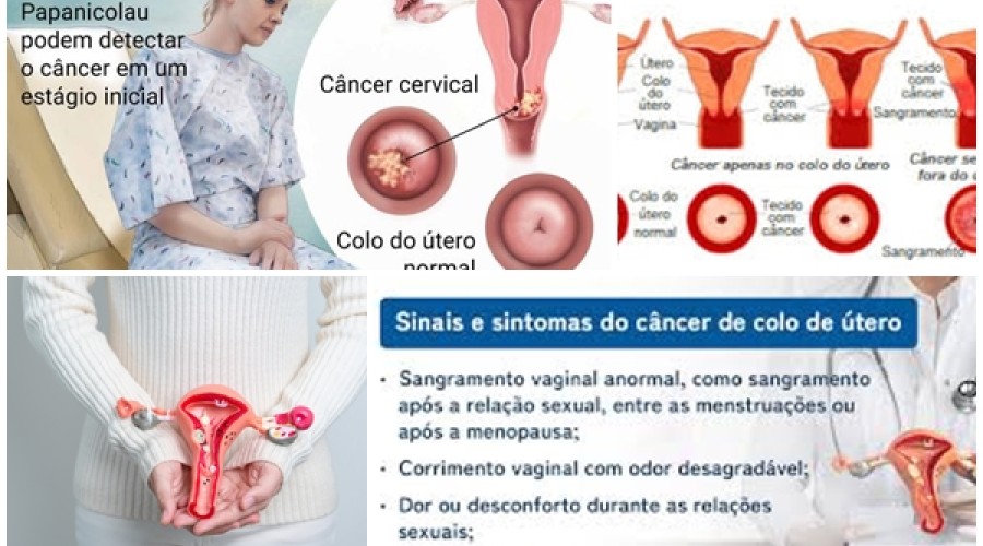 Saúde: Vídeo - O que é Câncer de colo do útero, Sintomas, Causas e tratamento