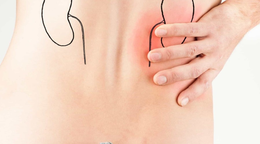 Pedra nos rins: como prevenir?