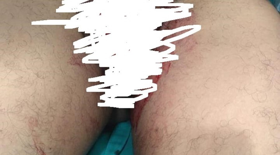 Em Timon, uma mulher arrancou ” os cunhão” do marido após descobrir que estava sendo chifrada