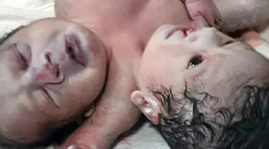 Com duas cabeças e três braços, nasce caso raríssimo de bebês siameses