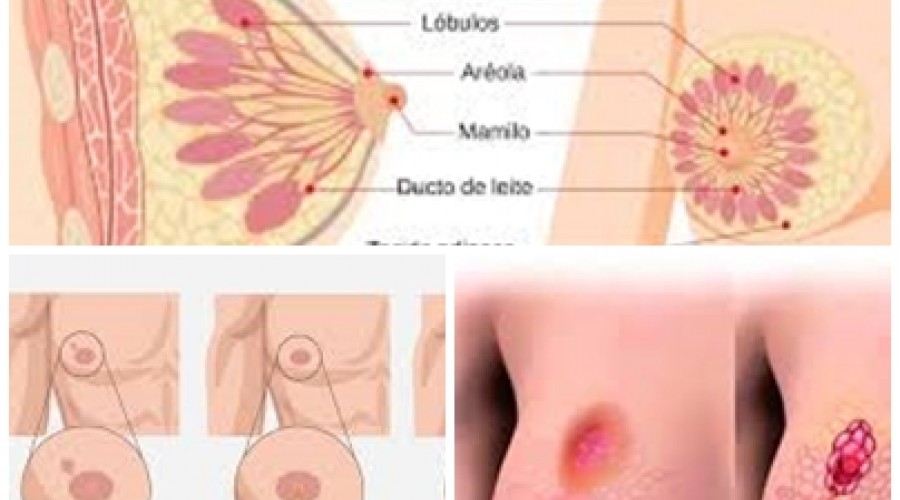 Saúde: “O paradoxo do câncer de mama: por que os países mais ricos registram mais casos que os pobres -Veja países com maior índice