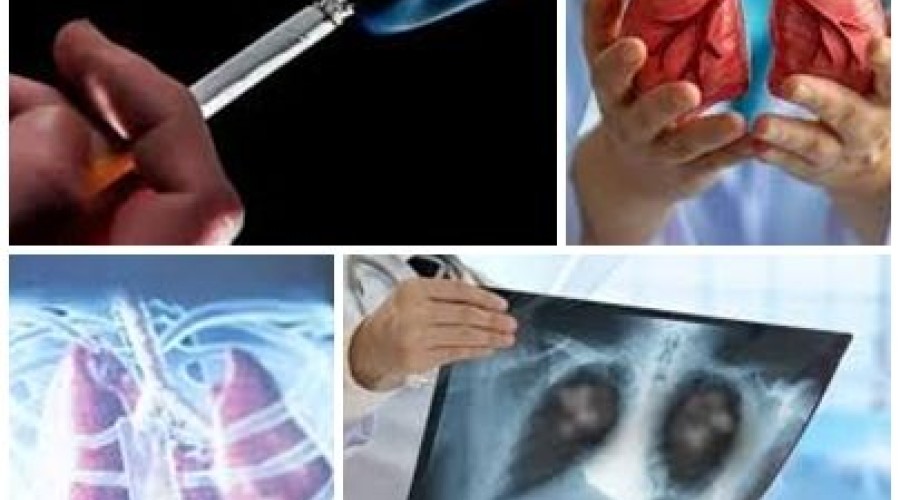 Inca anuncia estudo inédito para rastreamento do câncer de pulmão