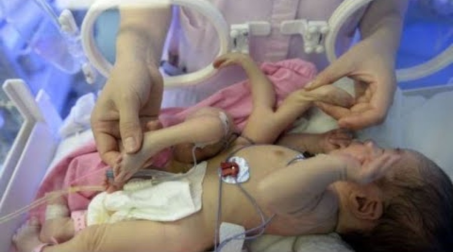 Caso raro: bebê nasce com 4 pernas e 6 mãos