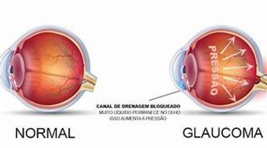 Glaucoma: Doença silenciosa pode ser tratada com colírios ou cirurgia! Entenda!