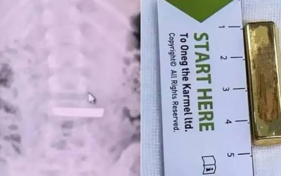 Menina de 5 anos engole barra de ouro de R$ 37 mil e precisa de cirurgia de emergência; veja!