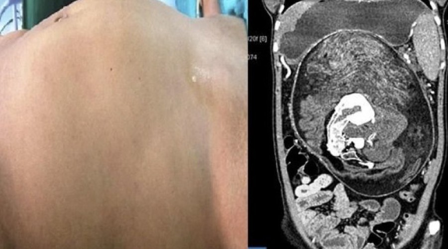 Jovem internada com dor descobre que carregava irmão gêmeo malformado na barriga
