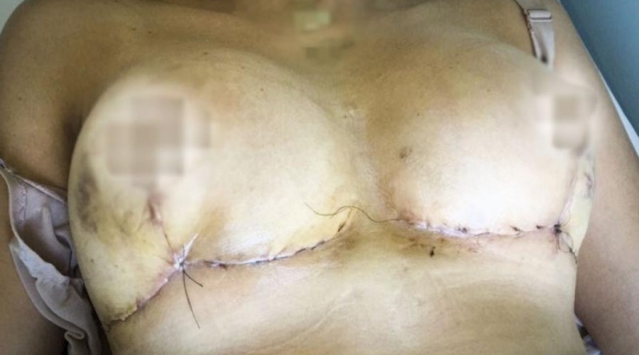 “Vergonha de ficar nua”, diz mulher que acusa cirurgião de erro