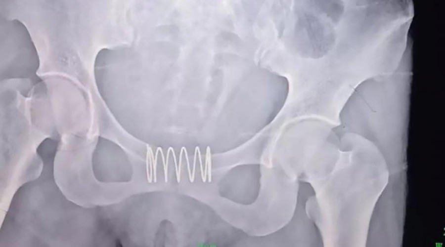 Mulher coloca mola na vagina achando que não iria engravidar