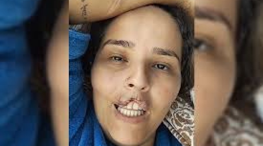 Sem avisar, marido manda matar chow-chow que arrancou lábio de mulher