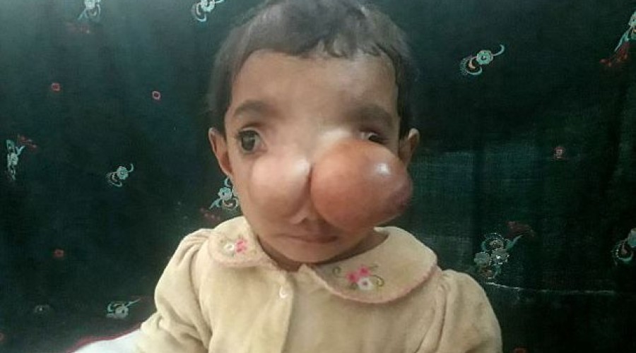 Menina do “nariz de elefante” é salva por uma cirurgia: confira o antes e o depois