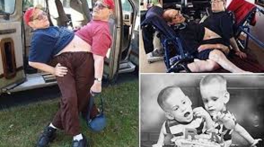 Morrem gêmeos siameses mais velhos do mundo