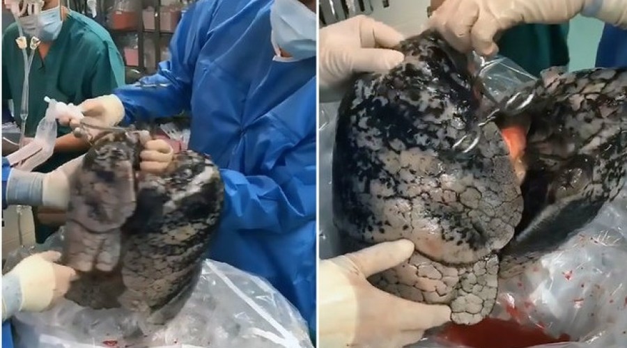 Chocante! Veja fotos do pulmão de um homem que fumou por 30 anos