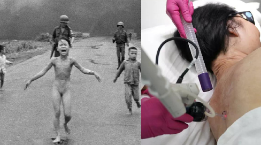 'Garota Napalm', famosa mundialmente por foto na Guerra do Vietnã, passa por último tratamento de pele depois de 50 anos